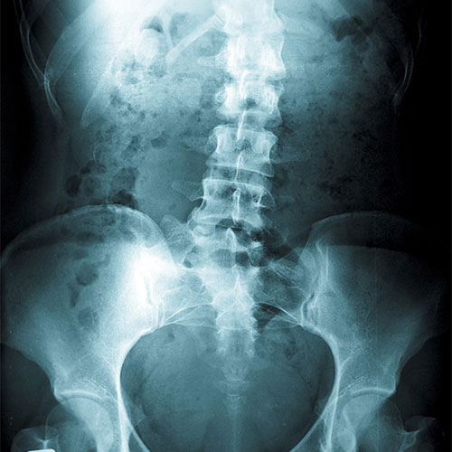 Scoliosis Correction Surgery - Florida Spine Institute